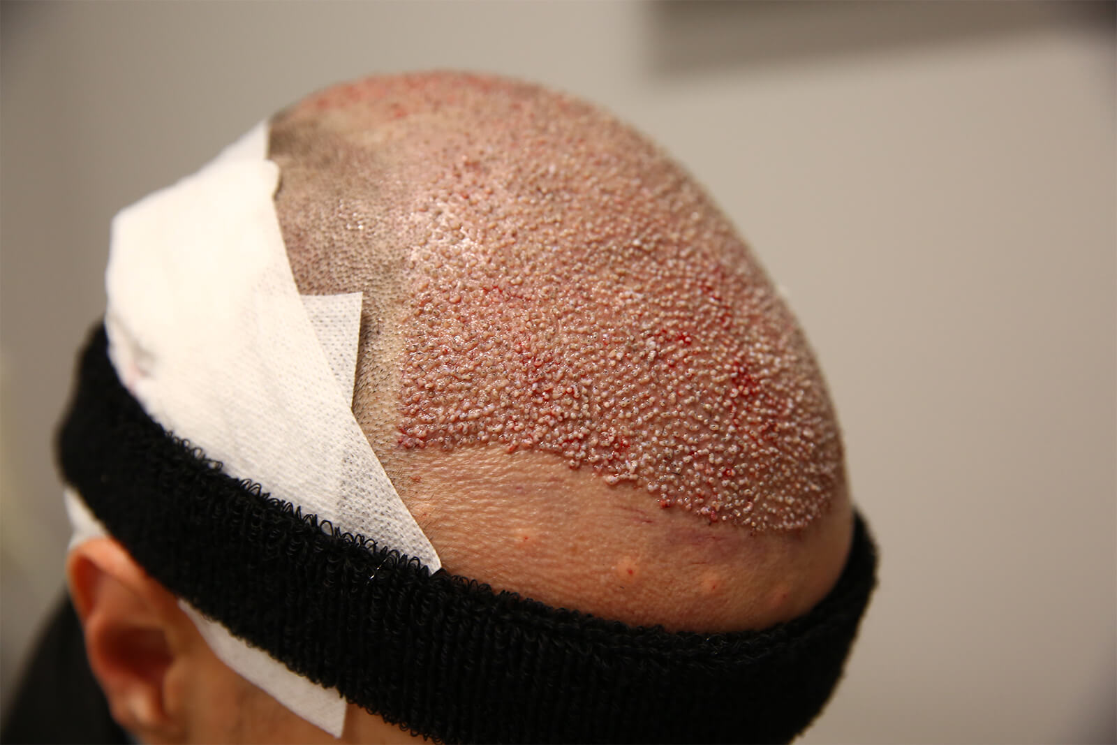After Hair Transplant Operation in Turkey