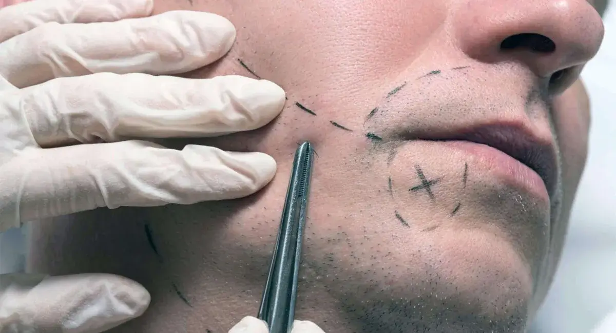 Beard Transplant Turkey