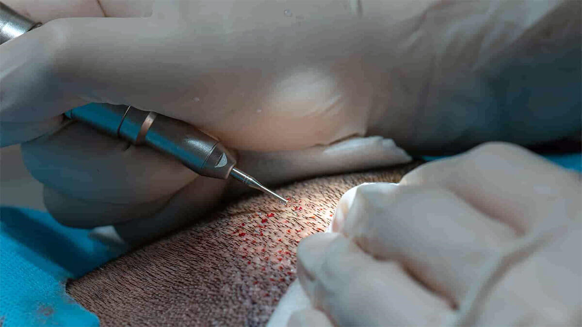 Before Hair Transplant Operation