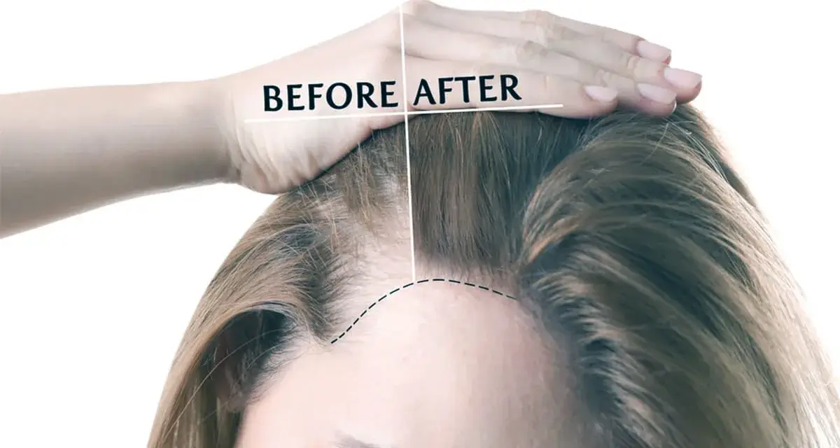 Hair Transplant for Women