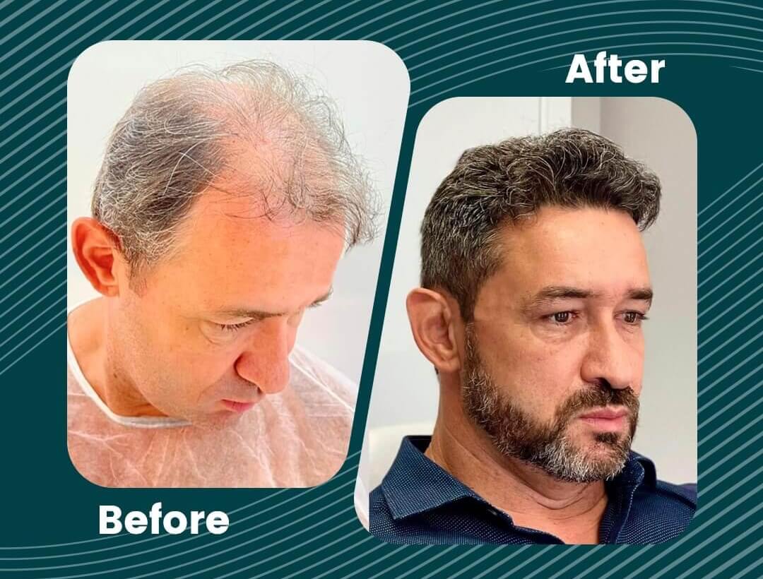 Turkey Hair Transplant Before and After