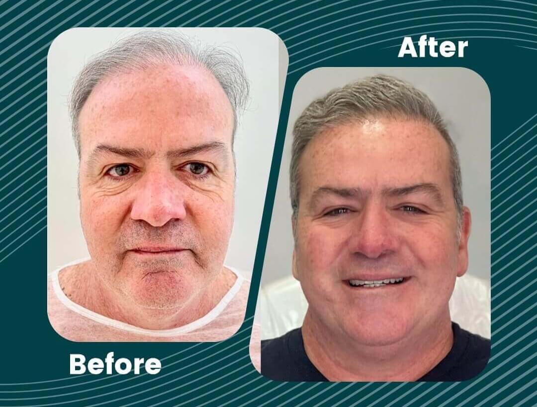 Turkey Hair Transplant Before and After
