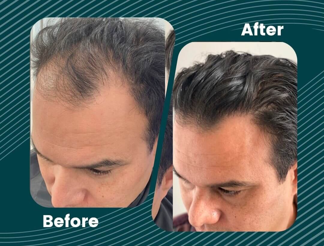 Turkey Hair Transplant Before and After