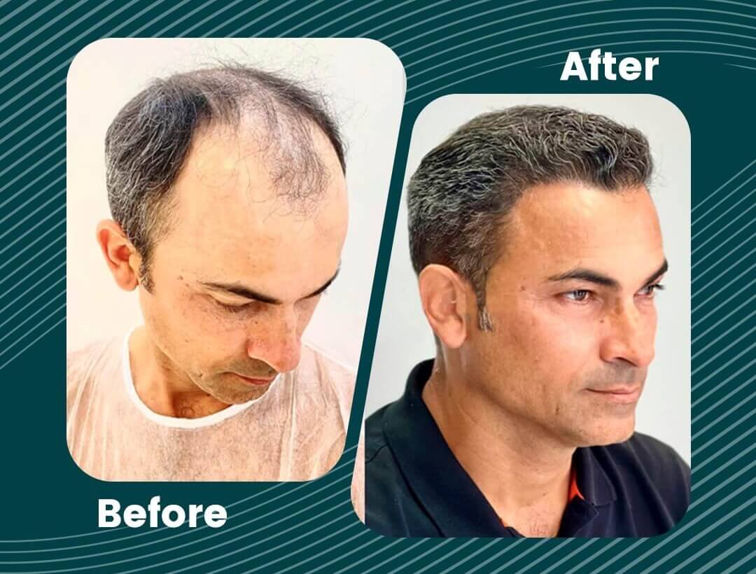 Turkey Hair Transplant Before and After