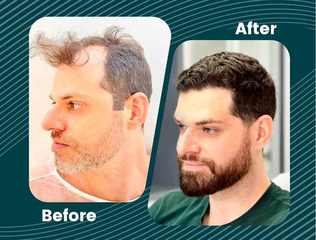 Turkey Hair Transplant Before and After
