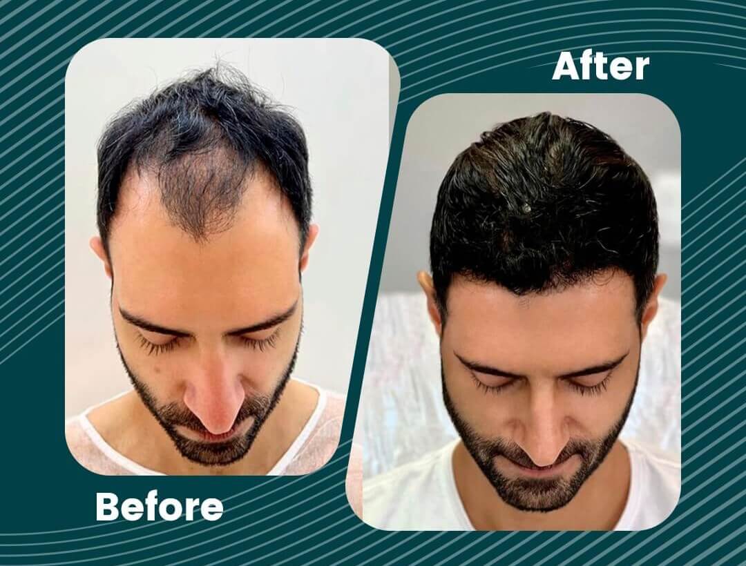 Turkey Hair Transplant Before and After