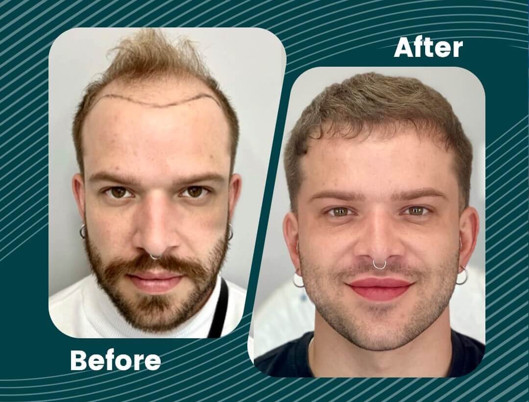 Turkey Hair Transplant Before and After