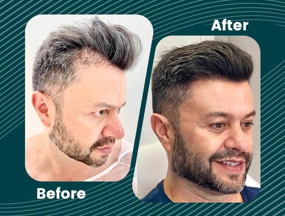 Turkey Hair Transplant Before and After