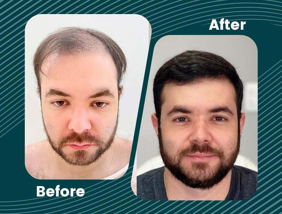 Turkey Hair Transplant Before and After