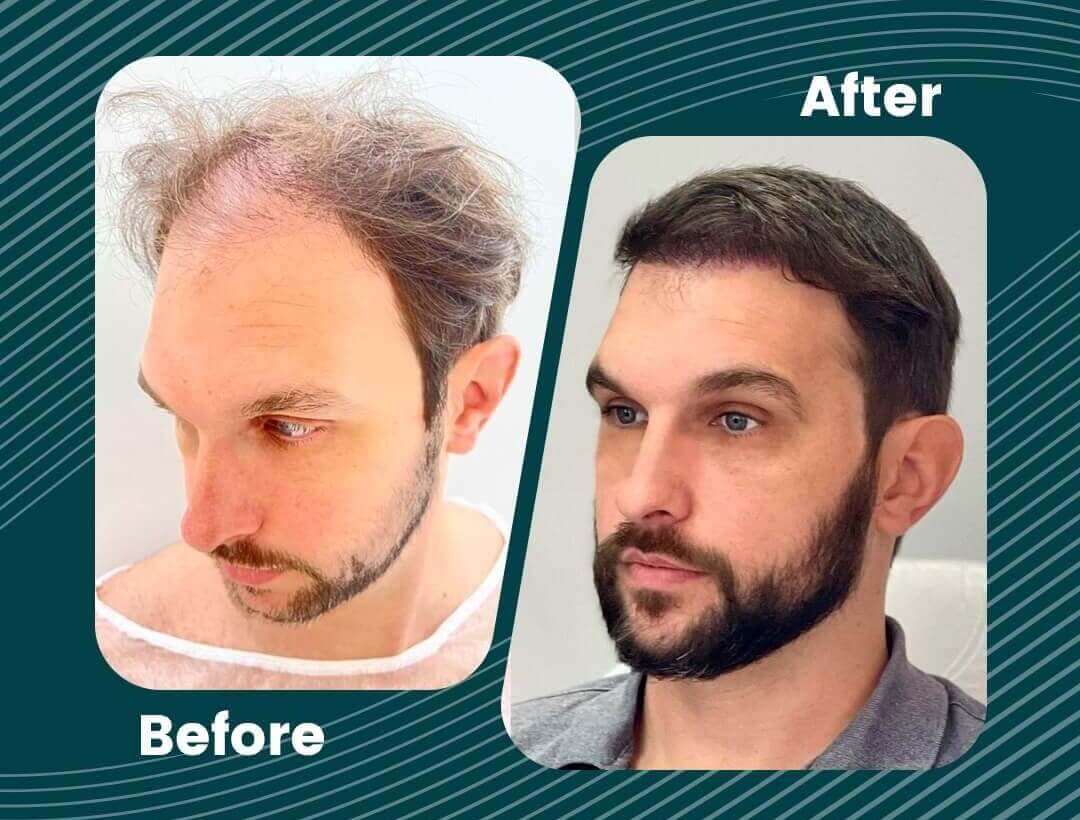 Turkey Hair Transplant Before and After