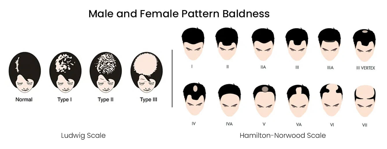 Male and Female Pattern Baldness: Hamilton-Norwood and Ludwig Scales