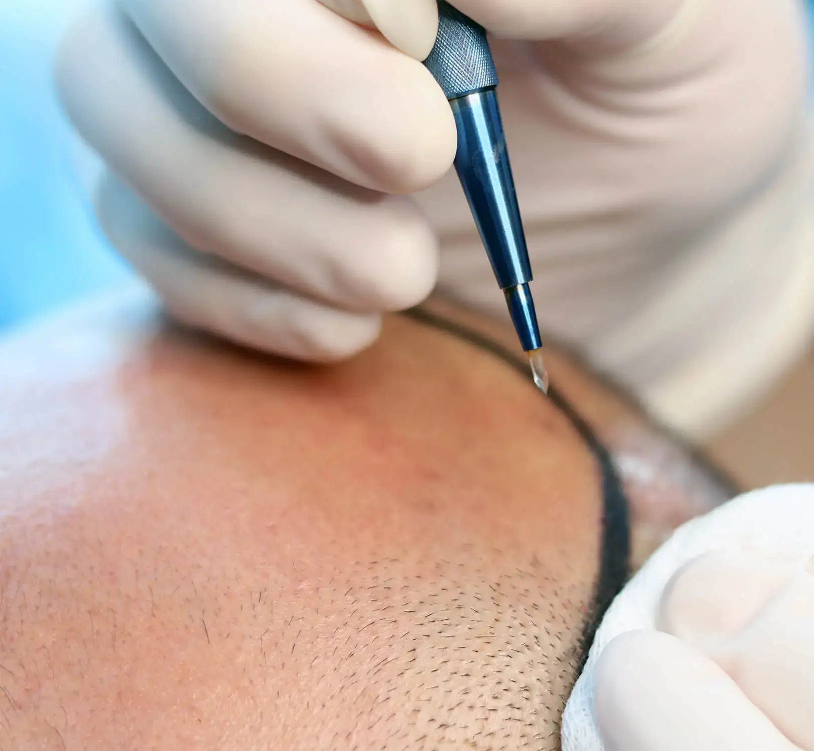 Sapphire FUE Hair Transplant in Turkey