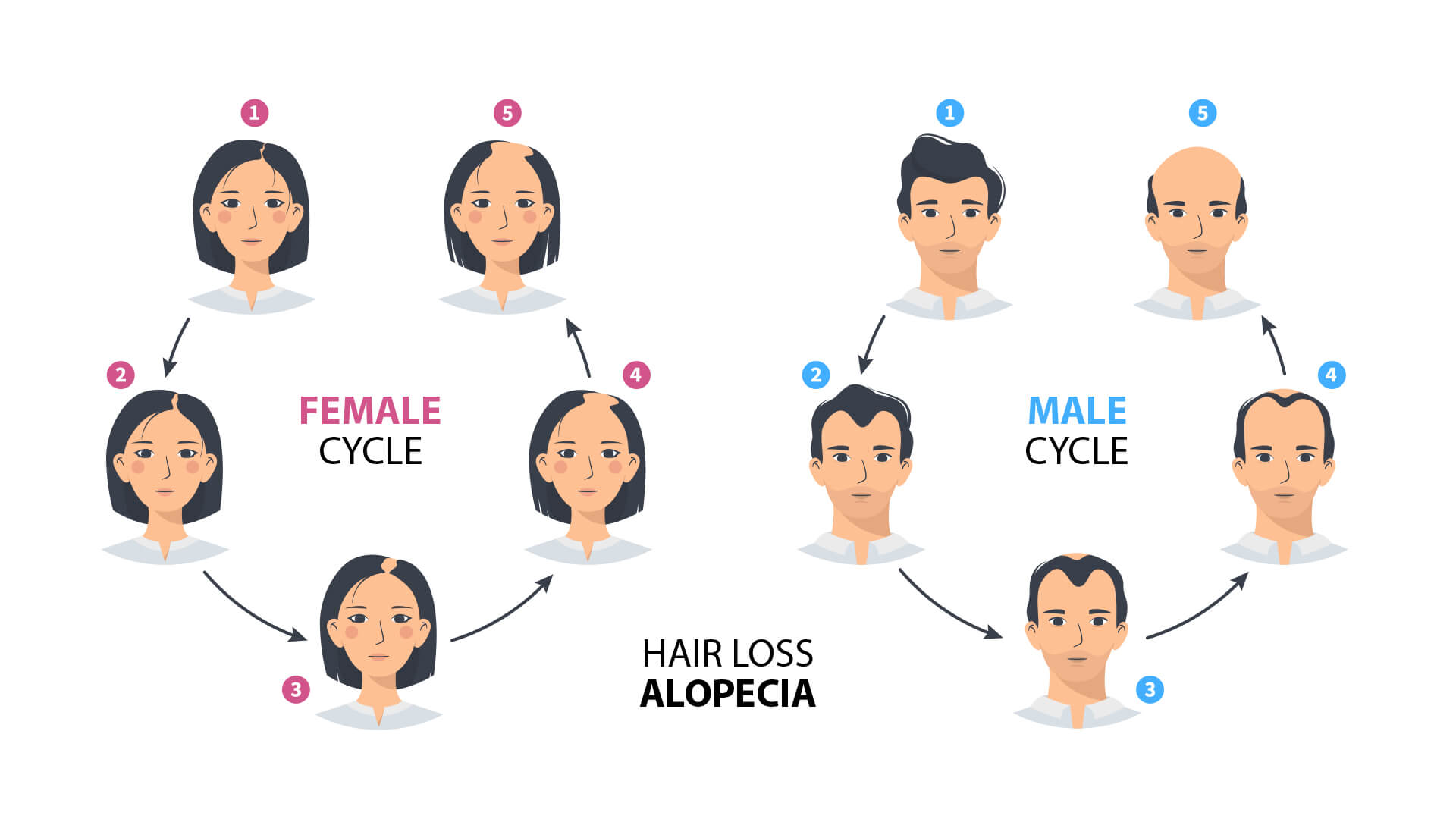 androgenetic alopecia