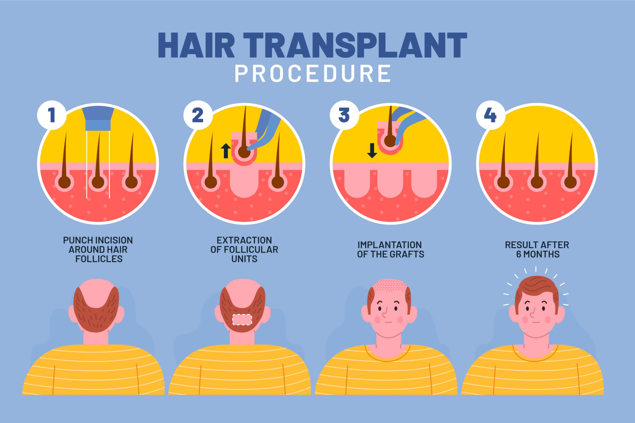 dhi hair transplant