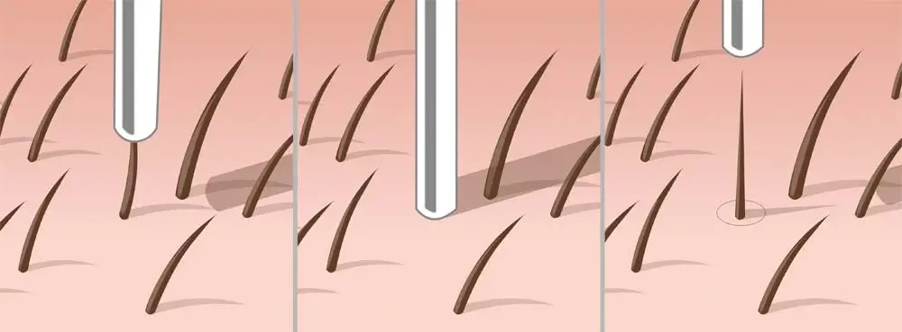 fue hair transplant 1