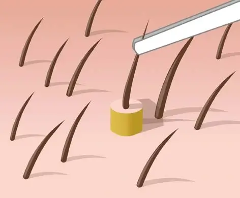 fue hair transplant 2