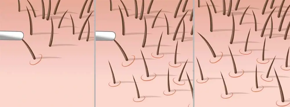 fue hair transplant 3