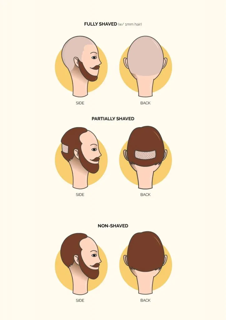 Three Methods of Performing FUE Hair Transplant