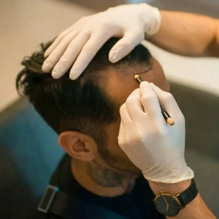 fue hair transplant