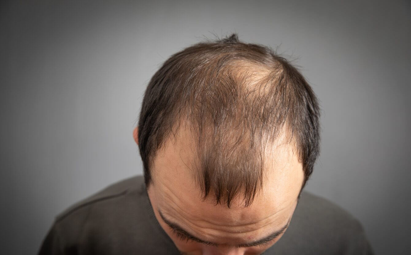 hair loss and baldness