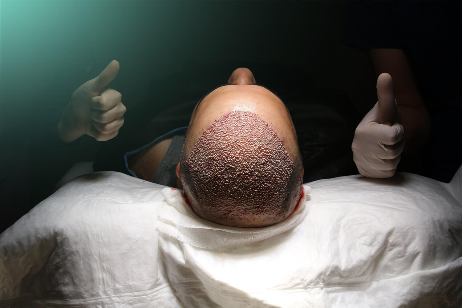 Hair Transplant Turkey