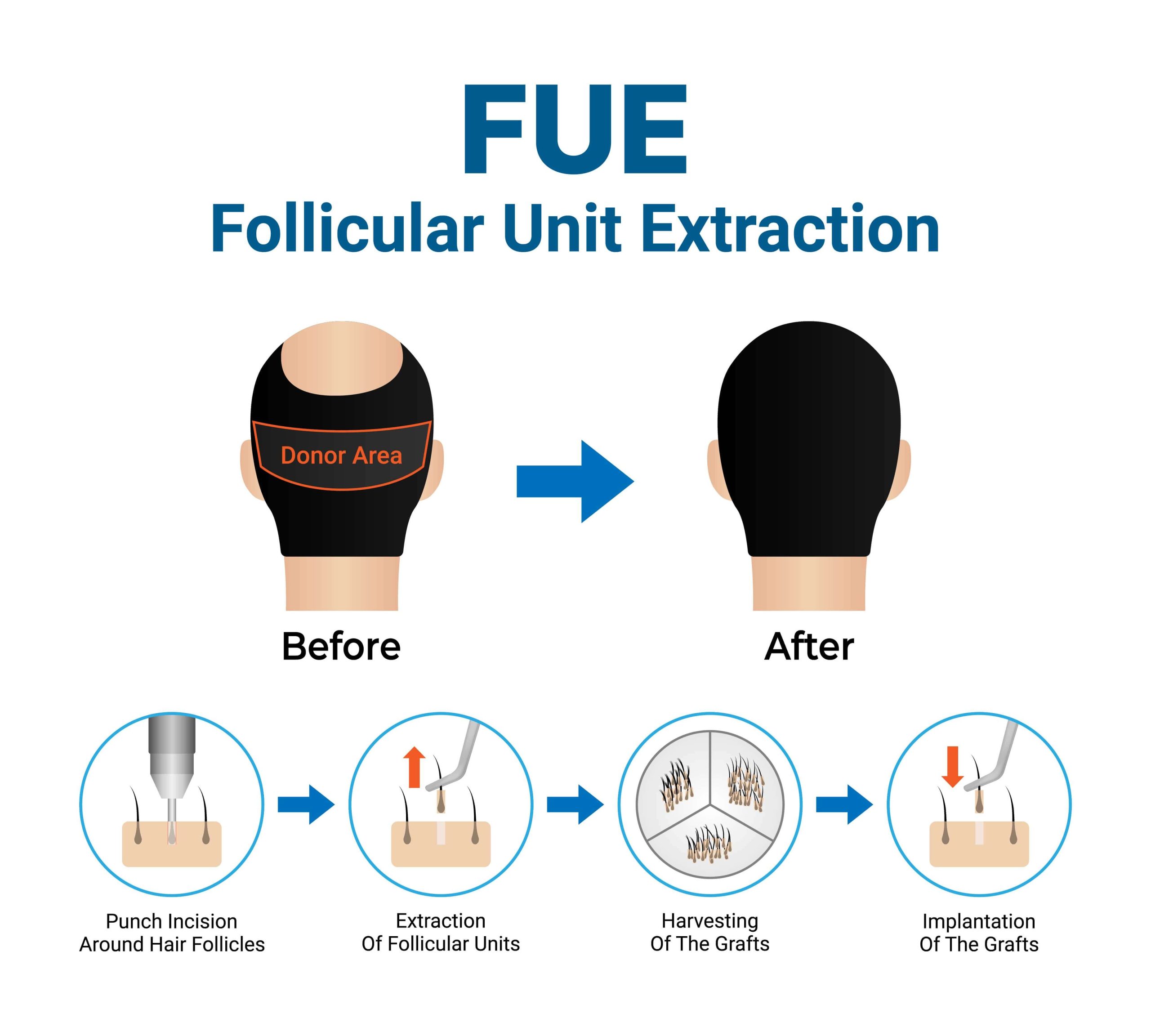 sapphire fue hair transplant