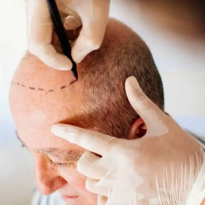sapphire fue hair transplant