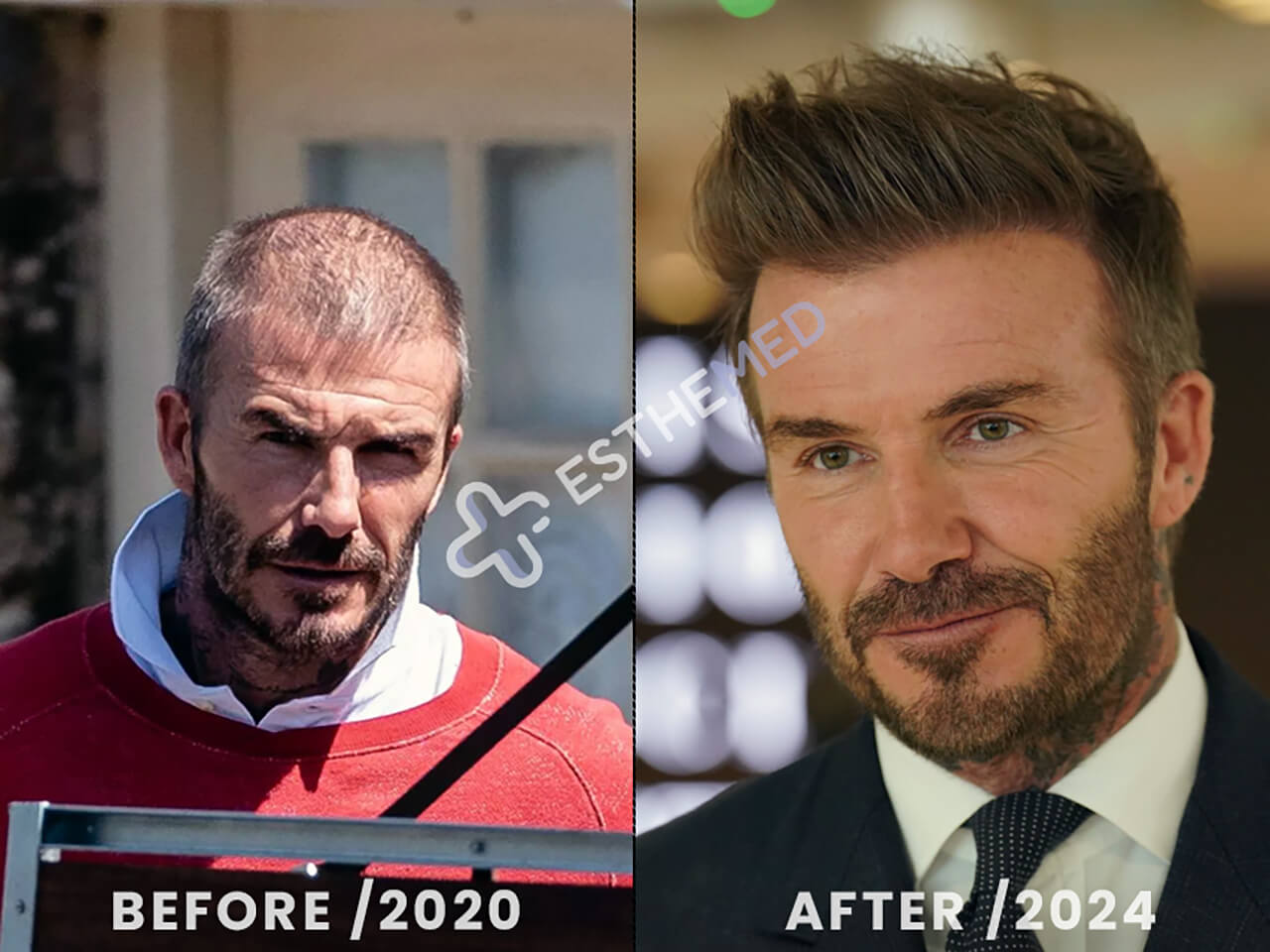 David Beckham Hair Transplant