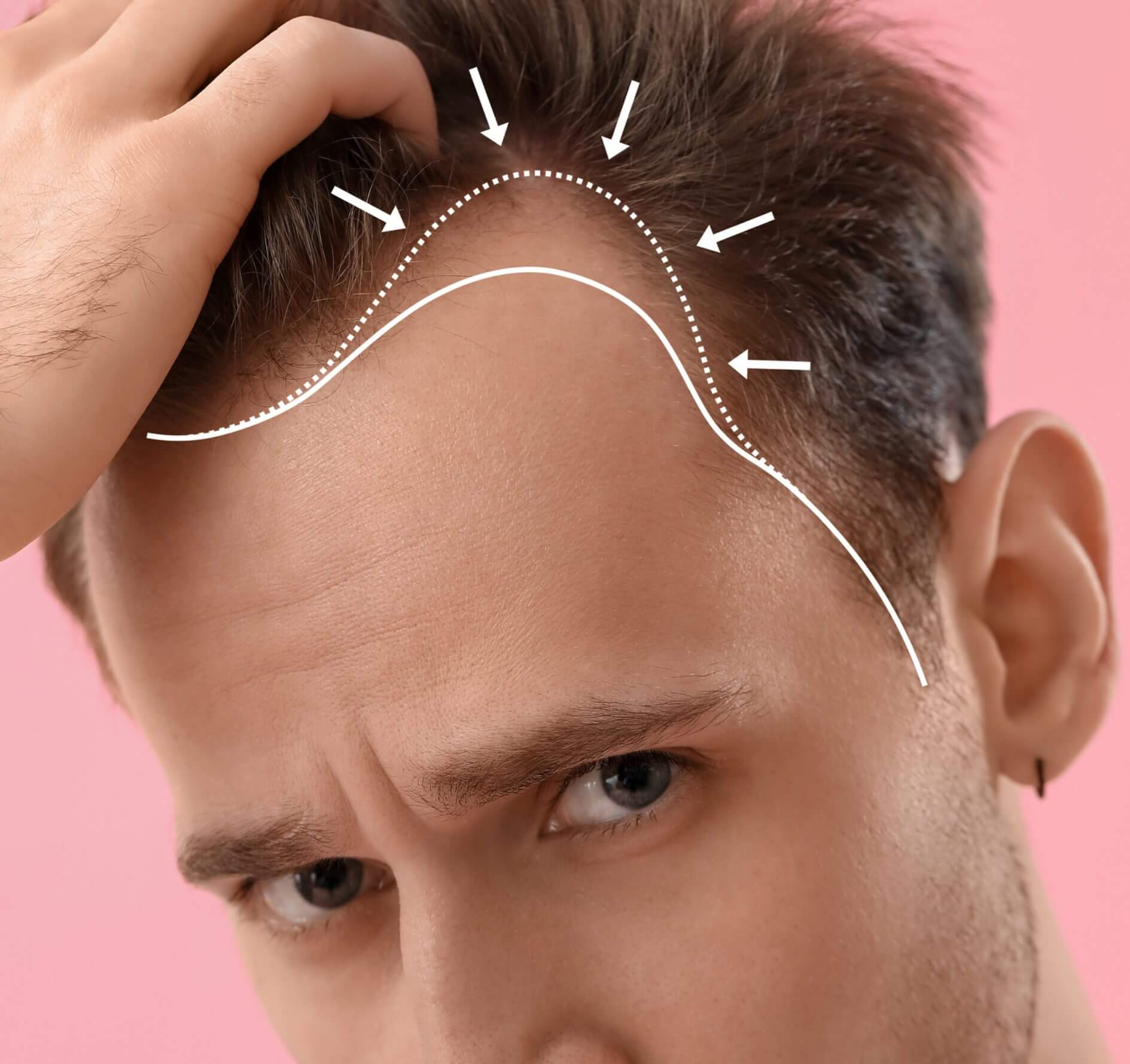 Hairline Loss: Causes, Treatments, and Solutions