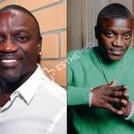 Akon Hair Transplant