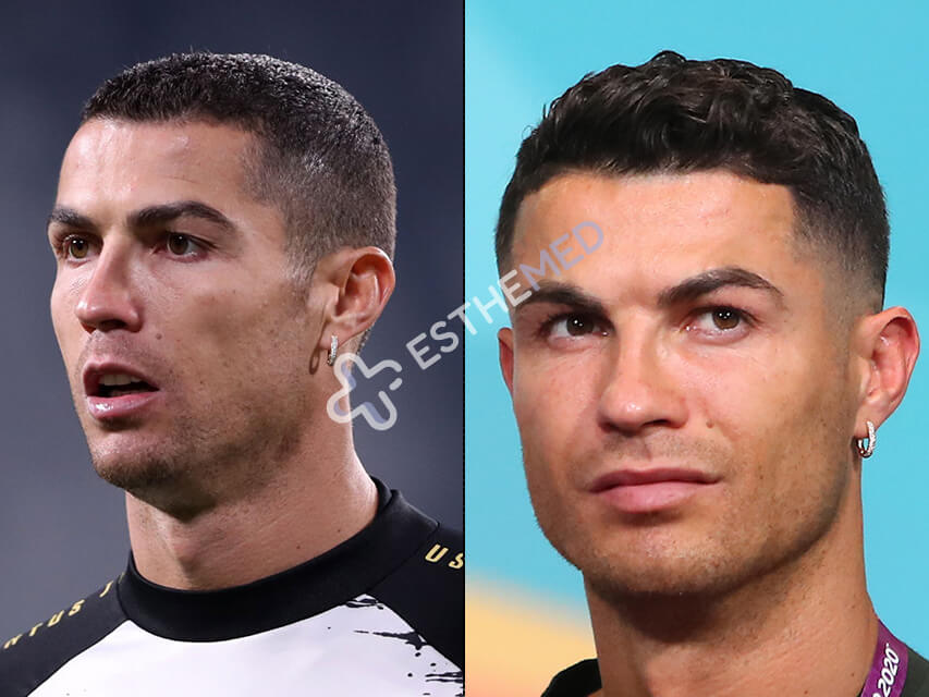 Cristiano Ronaldo Hair Transplant
