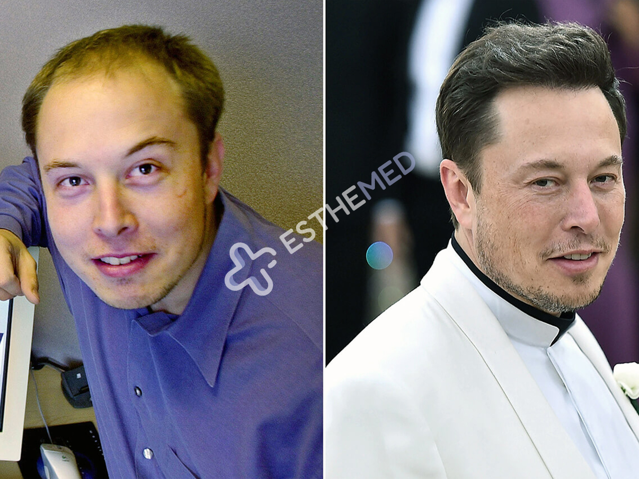 Elon Musk Hair Transplant