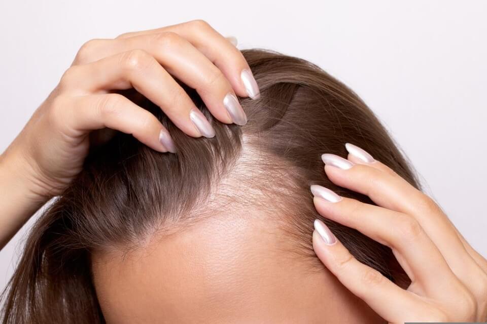 Male or Female Pattern Baldness: Causes, Differences, and Treatment Options