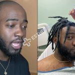 JiDion Hair Transplant