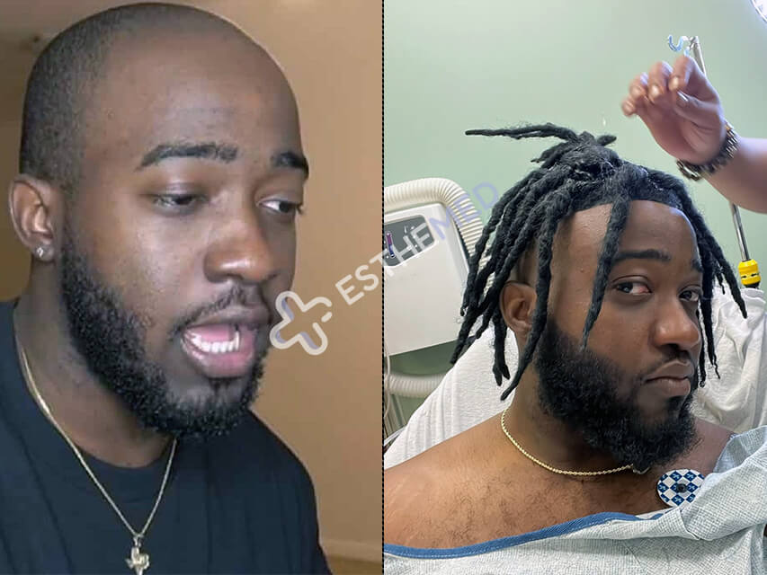 JiDion Hair Transplant