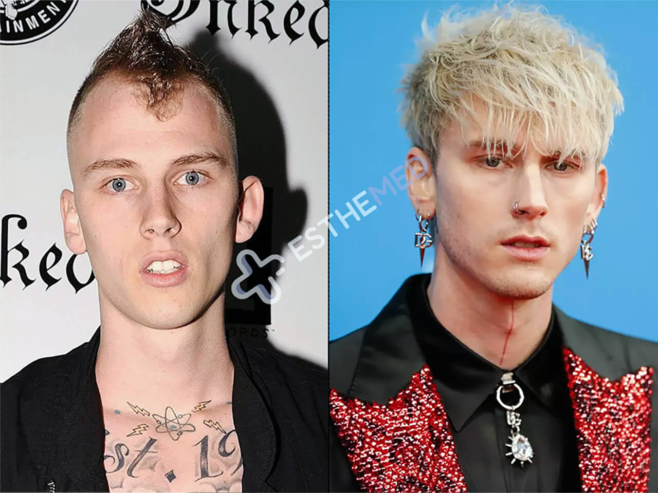 Machine Gun Kelly (MGK) Hair Transplant