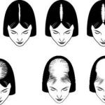Ludwig Scale: Understanding Female Pattern Hair Loss