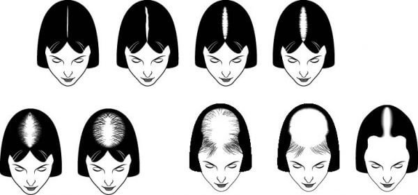 Ludwig Scale: Understanding Female Pattern Hair Loss