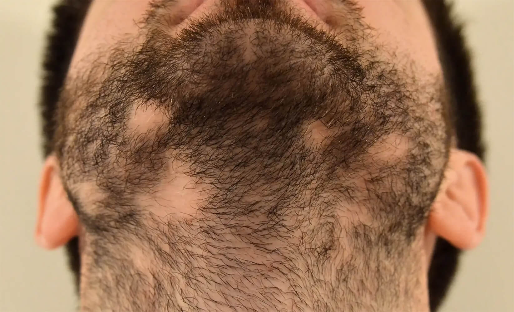 Alopecia Barbae: Causes, Diagnosis & Treatment