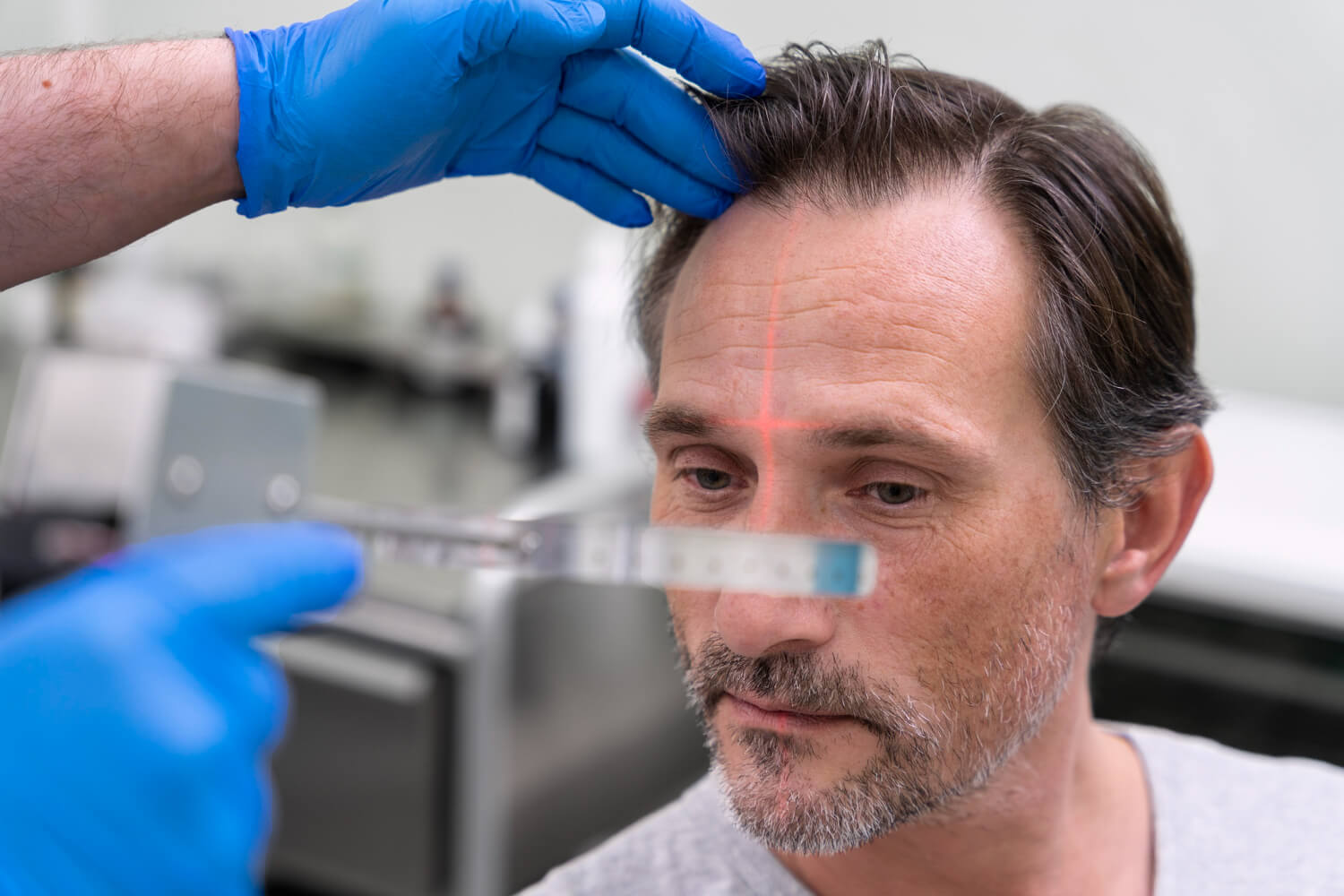 Alternatives to a Hair Transplant