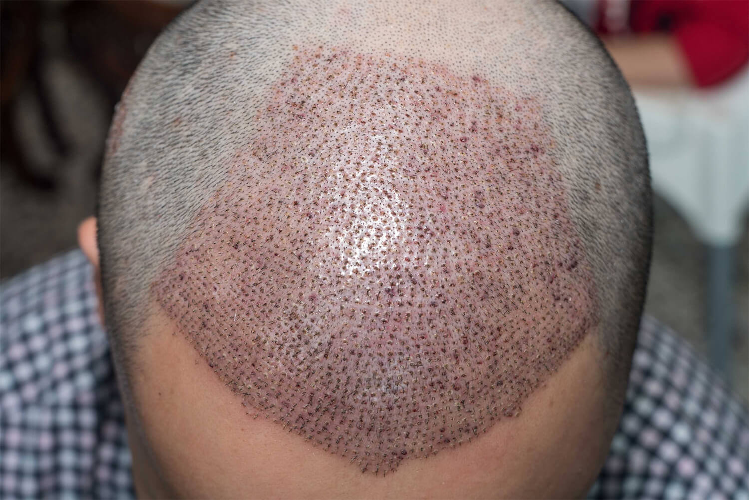 Hair Transplant Redness