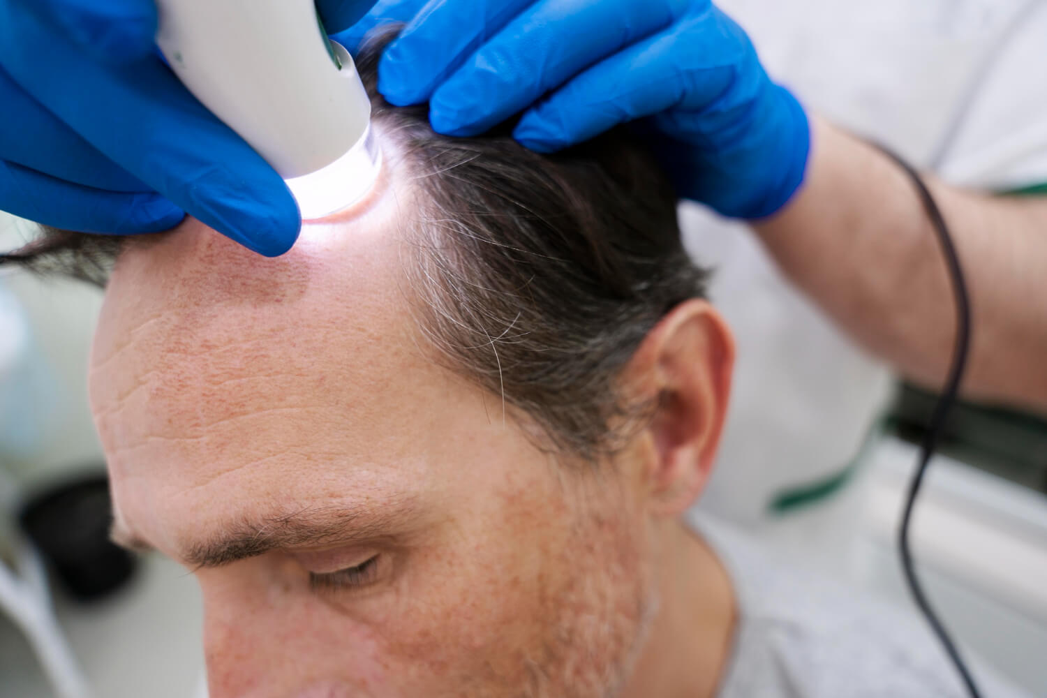 Ideal Age for Hair Transplant Surgery