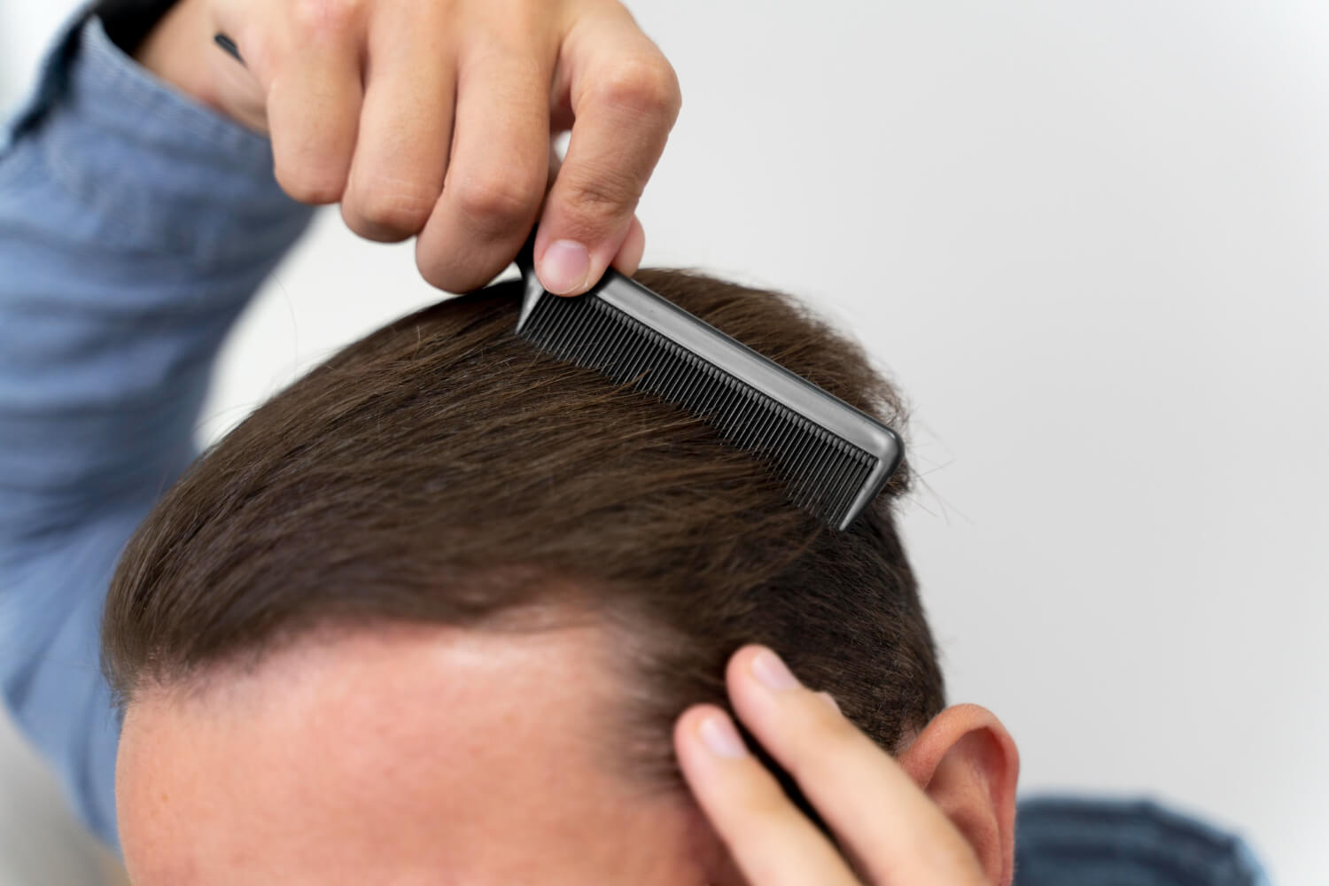 Is a Hair Transplant Permanent?