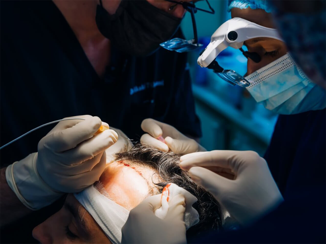 Is Going Abroad for a Hair Transplant Safe?