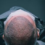 What Is the Success Rate of Hair Transplants?