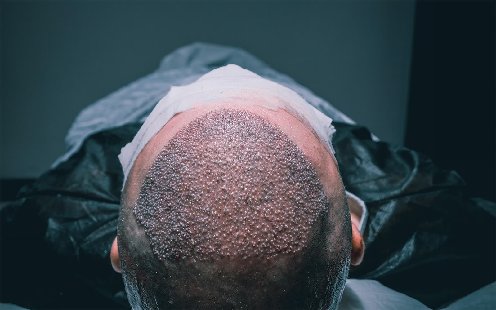 What Is the Success Rate of Hair Transplants?