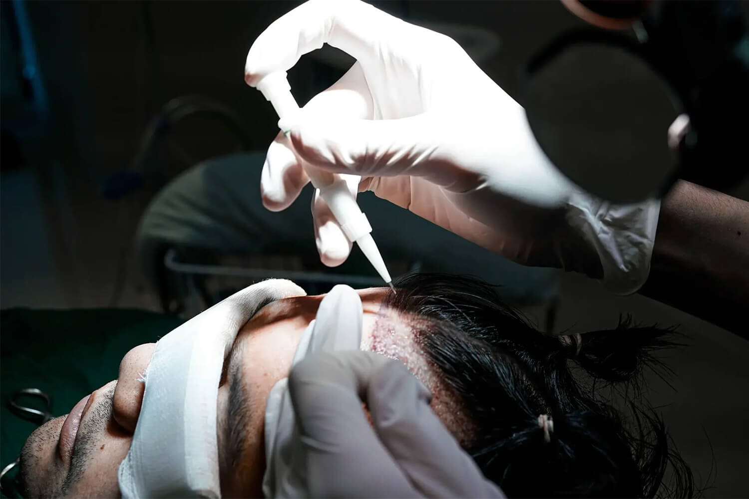 DHI Hair Transplant Turkey