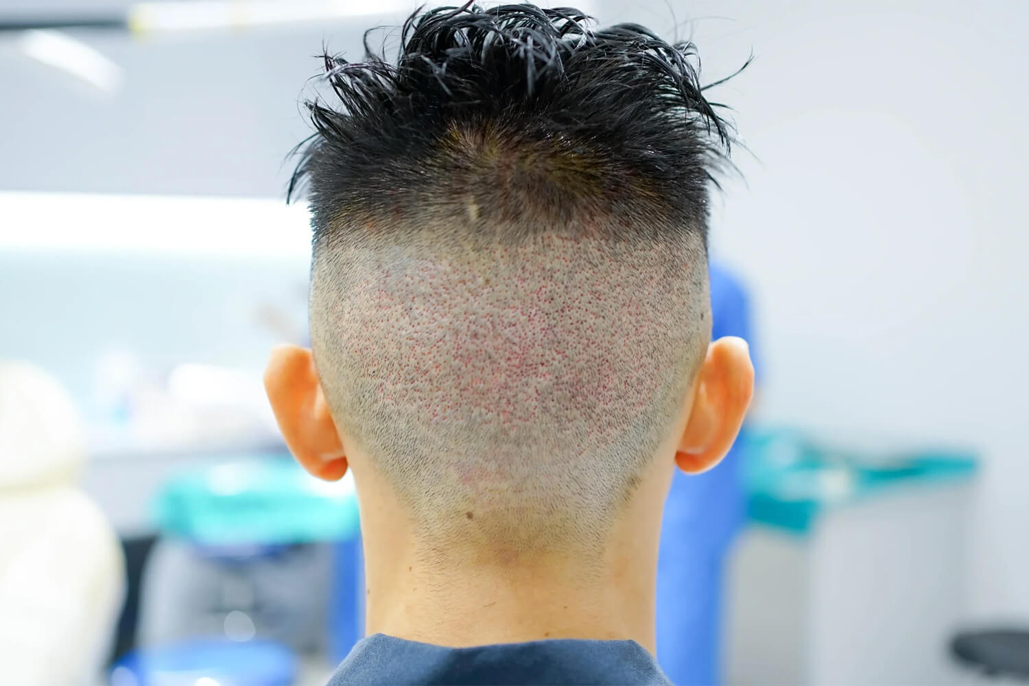 FUE Hair Transplant Turkey