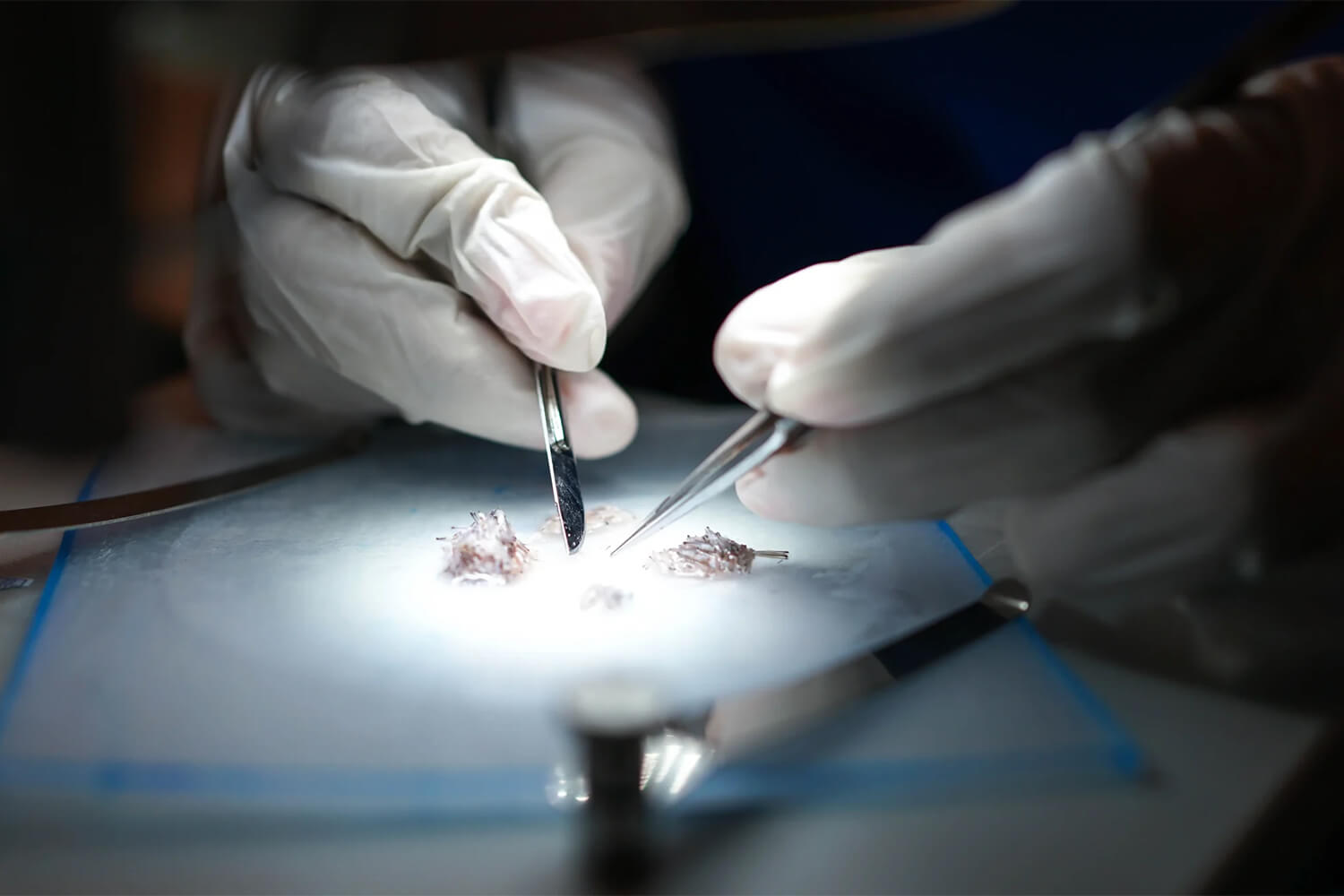 FUE Hair Transplantation