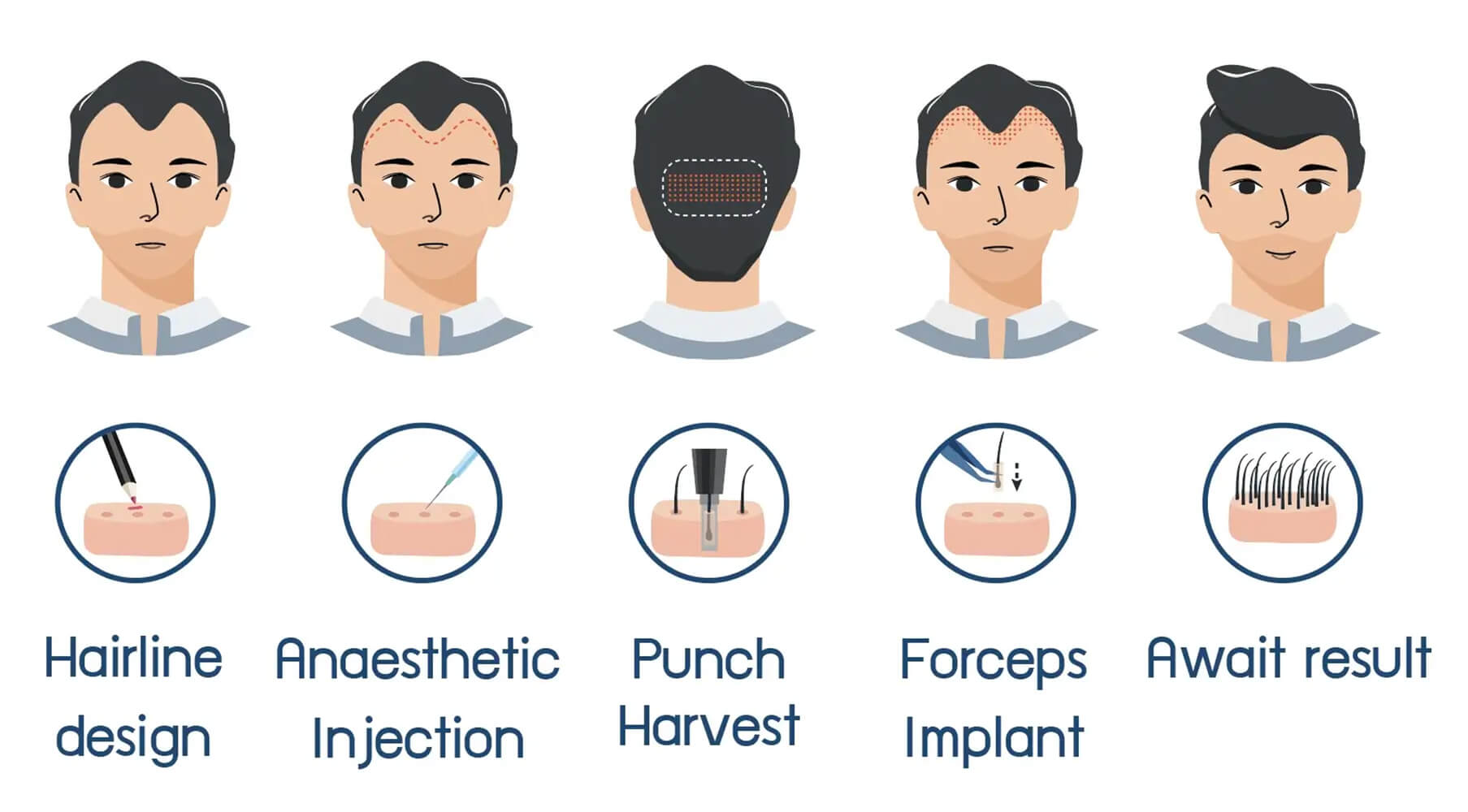Follicular Unit Extraction (FUE)